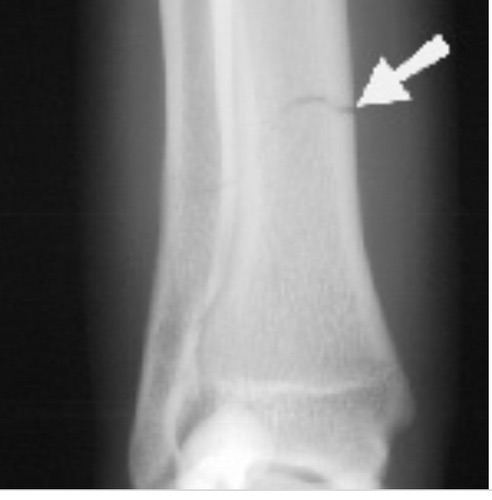 <p>Stress fracture</p>