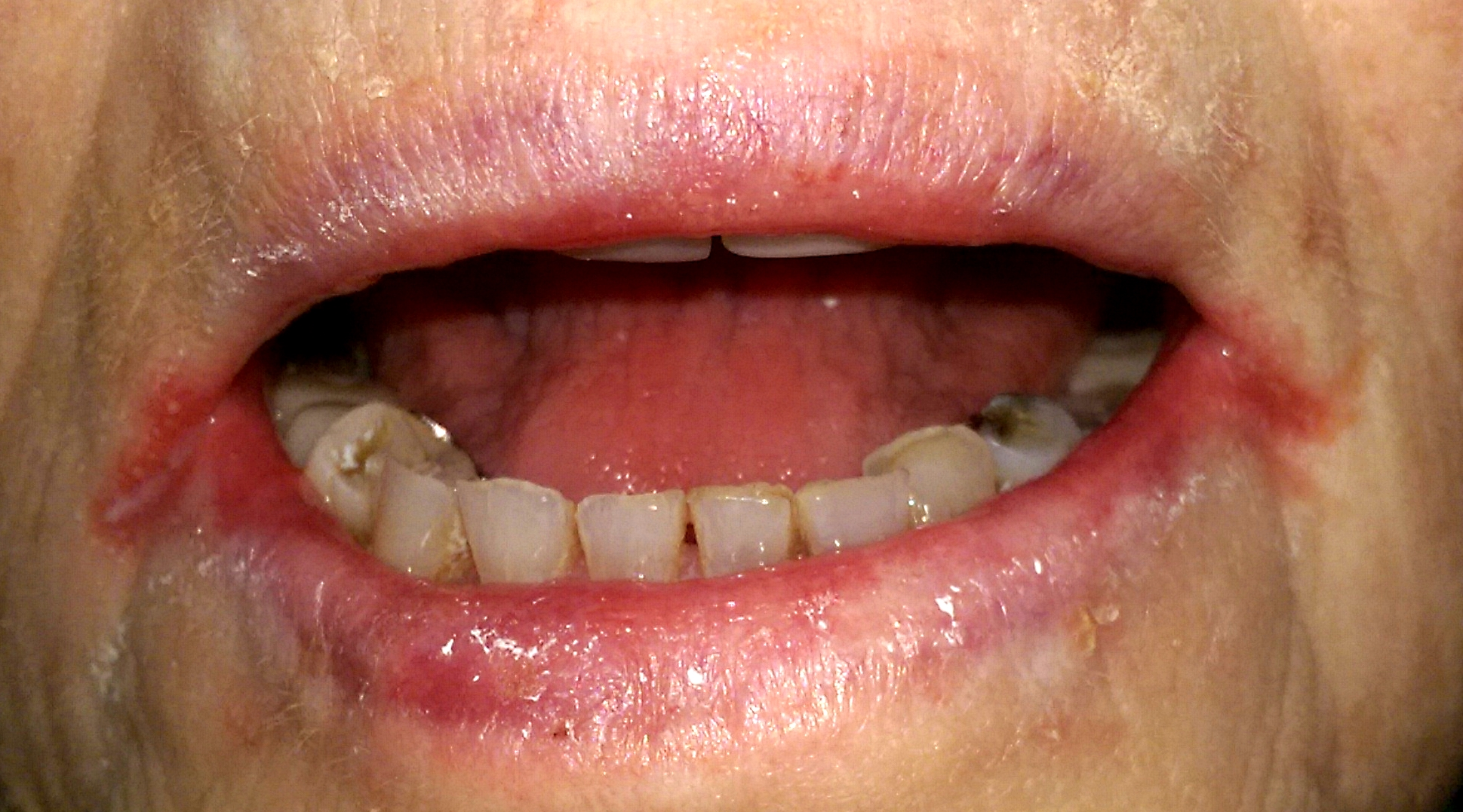 <p>PP: inflammation+painful cracking of the corner of the lips</p><p>E: saliva wetting<br>macerating skin<br>overclosure of mouth<br>nutritional deficiency</p>