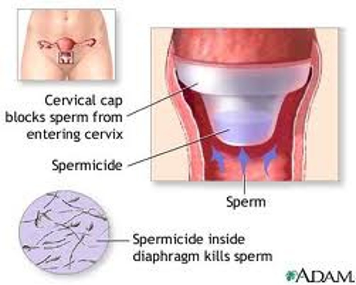 <p>before sexual intercourse the diaphragm or cervical cap is inserted in the vagina with spermicide to block or kill sperm + prescribed by provider</p>