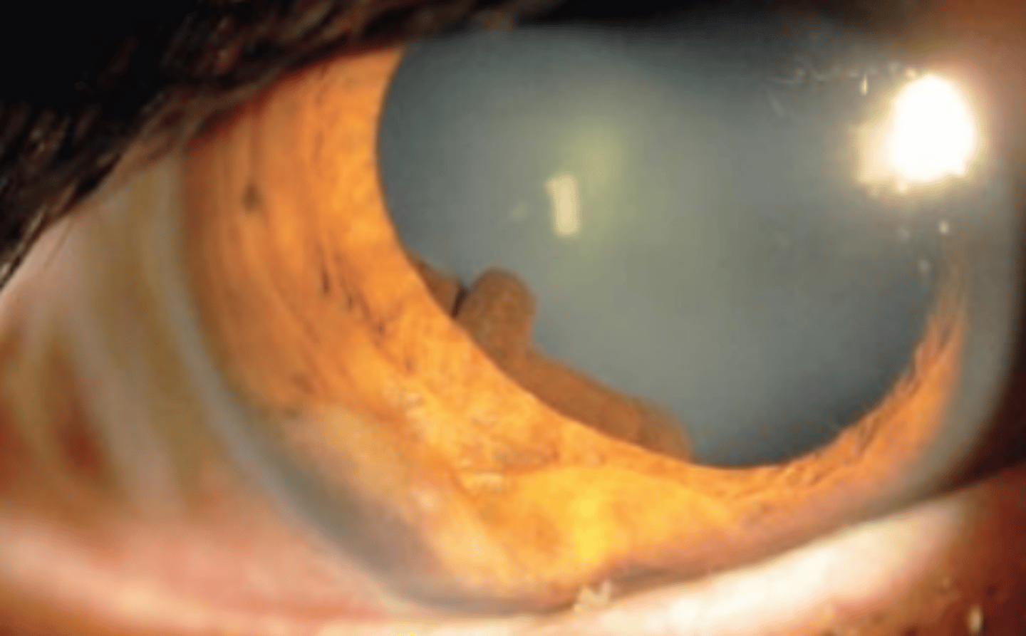 <p>primary iris cyst appearance as a globular, dark brown, lesion.</p>