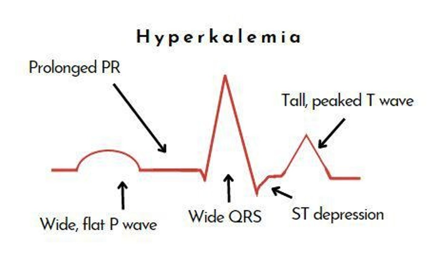 <p>Peaked (tall, tent shaped) T waves, widened QRS complex, and in severe cases a sine wave pattern; these changes indicate dangerously elevated potassium levels</p>