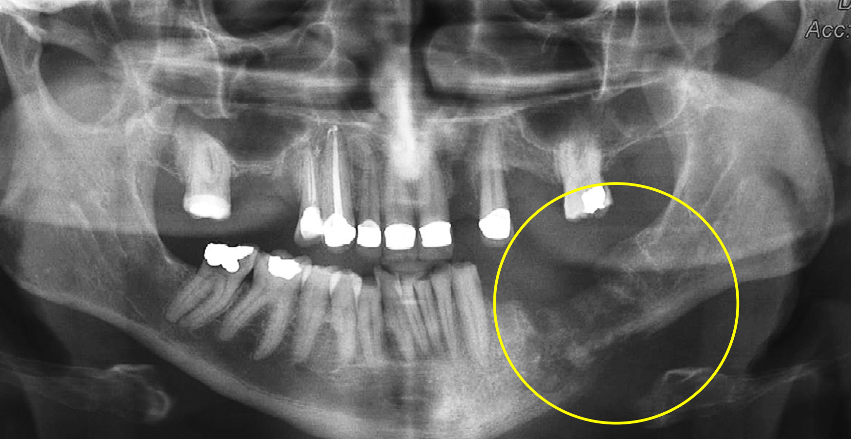 <p>which osteomyelitis phase? </p><p>periphery:</p><ul><li><p>poorly defined</p></li><li><p>non-corticated</p></li><li><p>gradual transition to normal trabeculae</p></li></ul><p></p>
