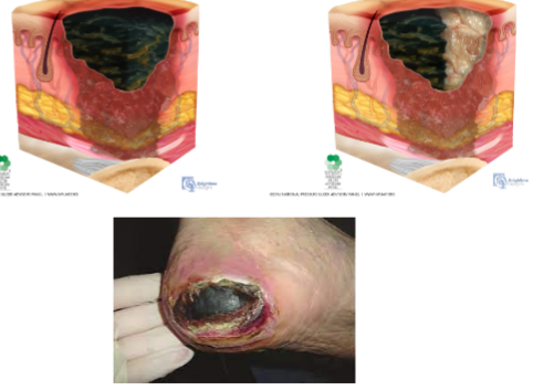 <ul><li><p>full thickness skin &amp; tissue loss to extent that damage cannot be confirmed due to slough or eschar obscuring it</p></li></ul><p></p>