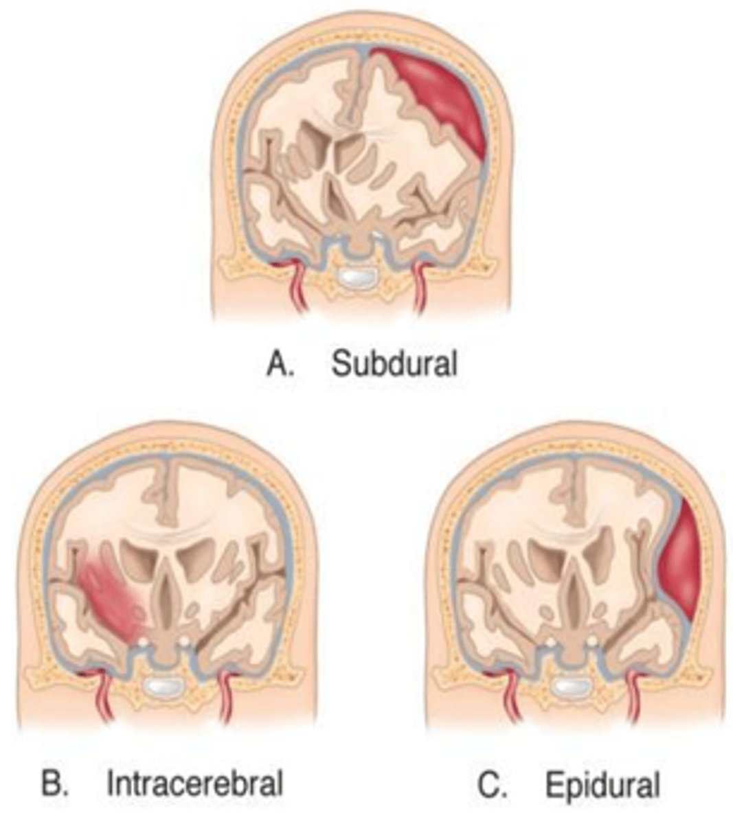 <p>Associated with a direct blow or acceleration-deceleration injury and can vary in size</p><p>.• Differs from a laceration - the pia mater remains intact</p><p>• Differs from a hematoma - blood is intermixed with brain tissue</p>