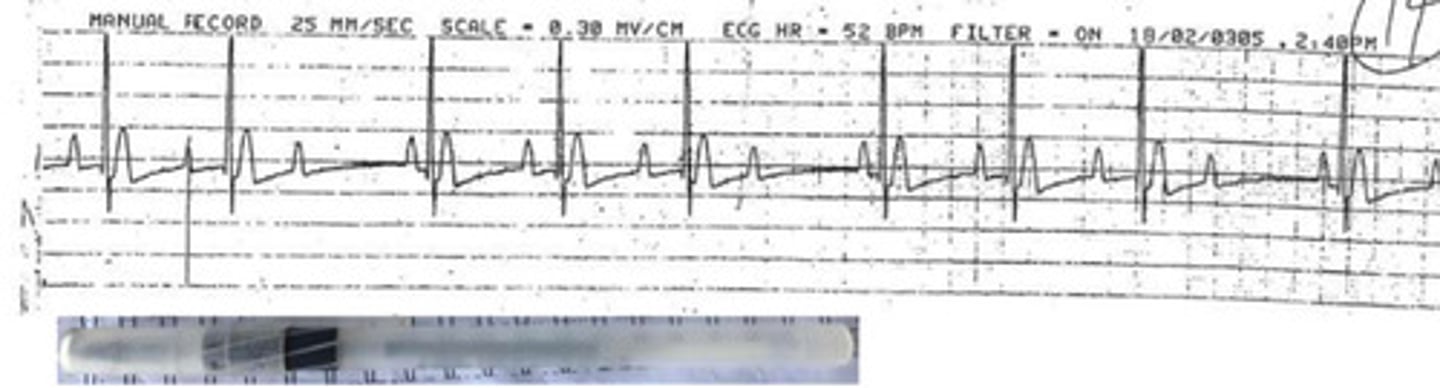 <p>What arrhythmia is this?</p>