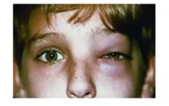 <p>preseptal cellulitis </p>