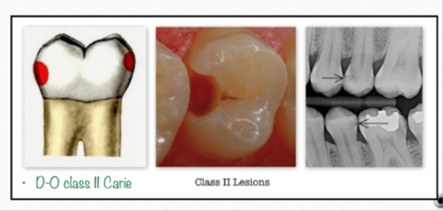 <p>GV Black Classification of Caries:</p><p>- Interproximal surfaces of posteriors</p><p>- Drop a BOX</p>