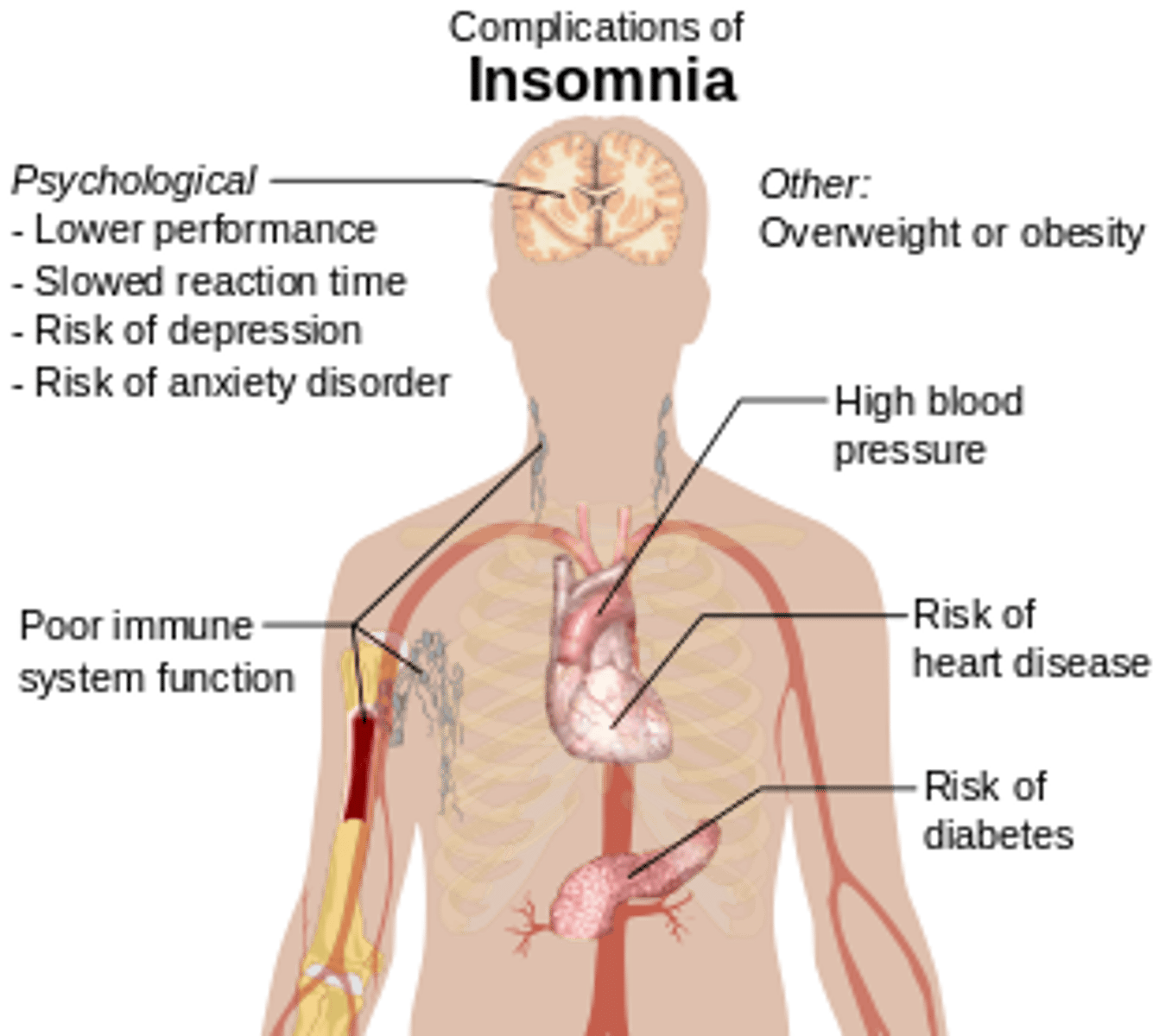 <p>(C) Insomnia</p><p>Insomnia refers to the persistent difficulty in falling asleep of staying asleep</p>