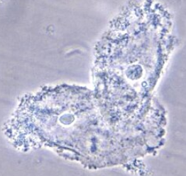 <p>Squamous epithelial cells covered in Gardnerella vaginalis</p><ul><li><p>from bacterial vaginosis</p></li><li><p>usually not reported in Urine results</p></li></ul><p></p>