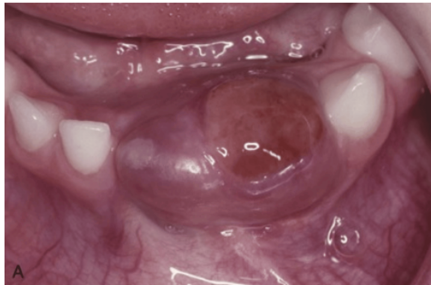 <p>How do aggressive Central Giant Cell Granulomas typically present?</p>