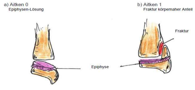 <p>a) Aitken 0</p><ul><li><p>Epiphysen-Lösung</p></li></ul><p>b) Aitken 1</p><ul><li><p>Fraktur am körpernahen Anteil</p></li></ul><p></p>