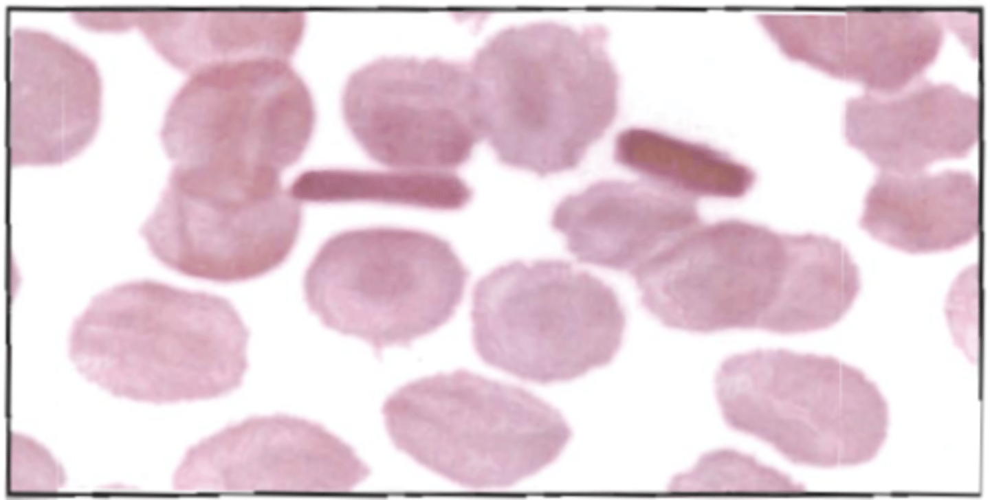 <p>88. With this blood picture, an additional test indicated is:</p><p>See BOC pg 159</p><p>A. alkali denaturation</p><p>B. alkaline phosphatase stain</p><p>C. peroxidase stain</p><p>D. hemoglobin electrophoresis</p>