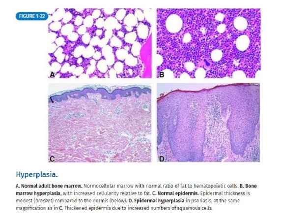 <p>breast during pregnancy - glandular proliferation</p><p>pathologic hyperplasia (can progress to dysplasia and cancer) - endometrial hyperplasia (exception is benign prostatic hyperplasia, which does not increase risk for prostate cancer)</p>