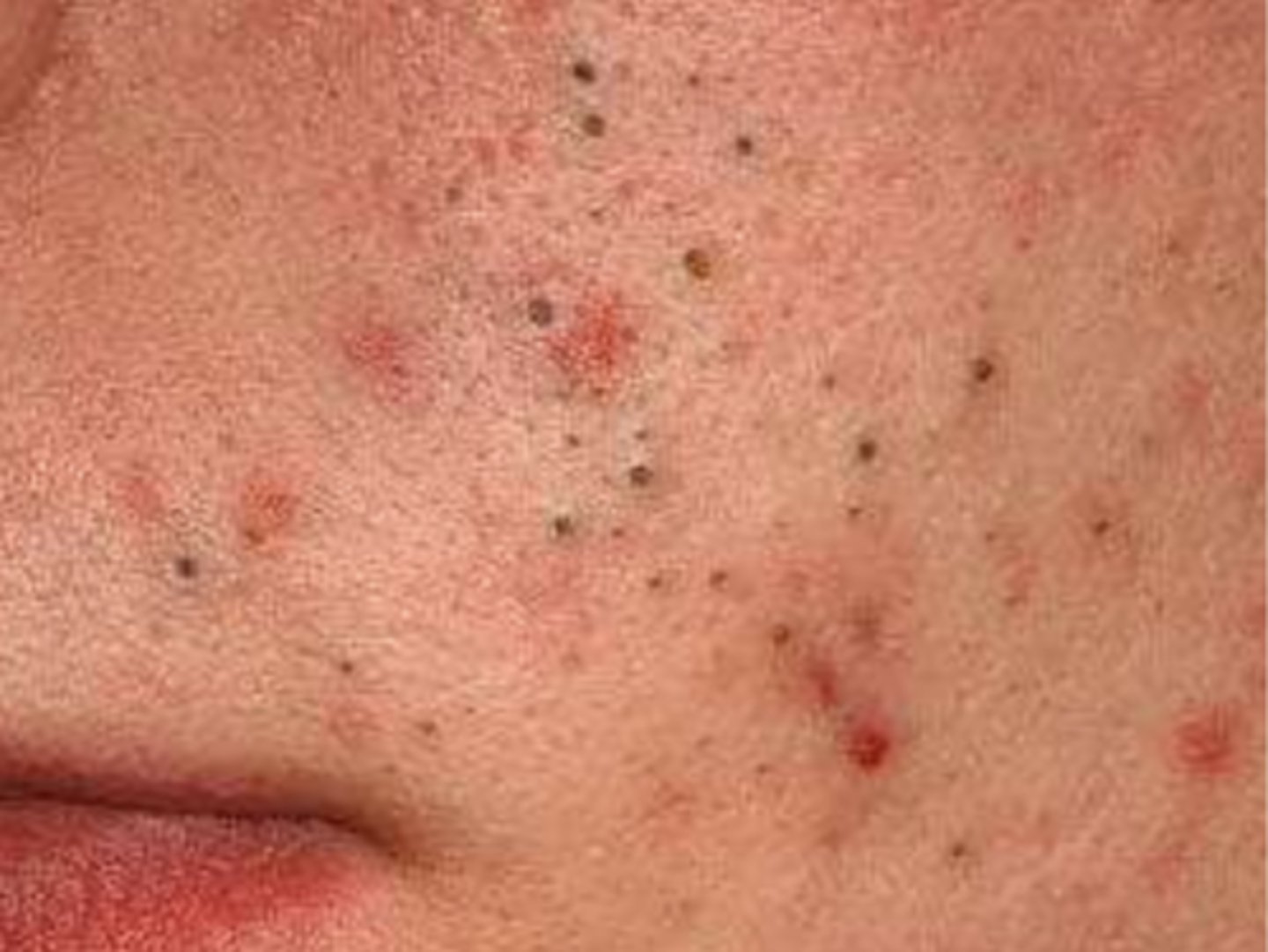 <p>¿lesión?</p><p>¿primaria o secundaria?</p>