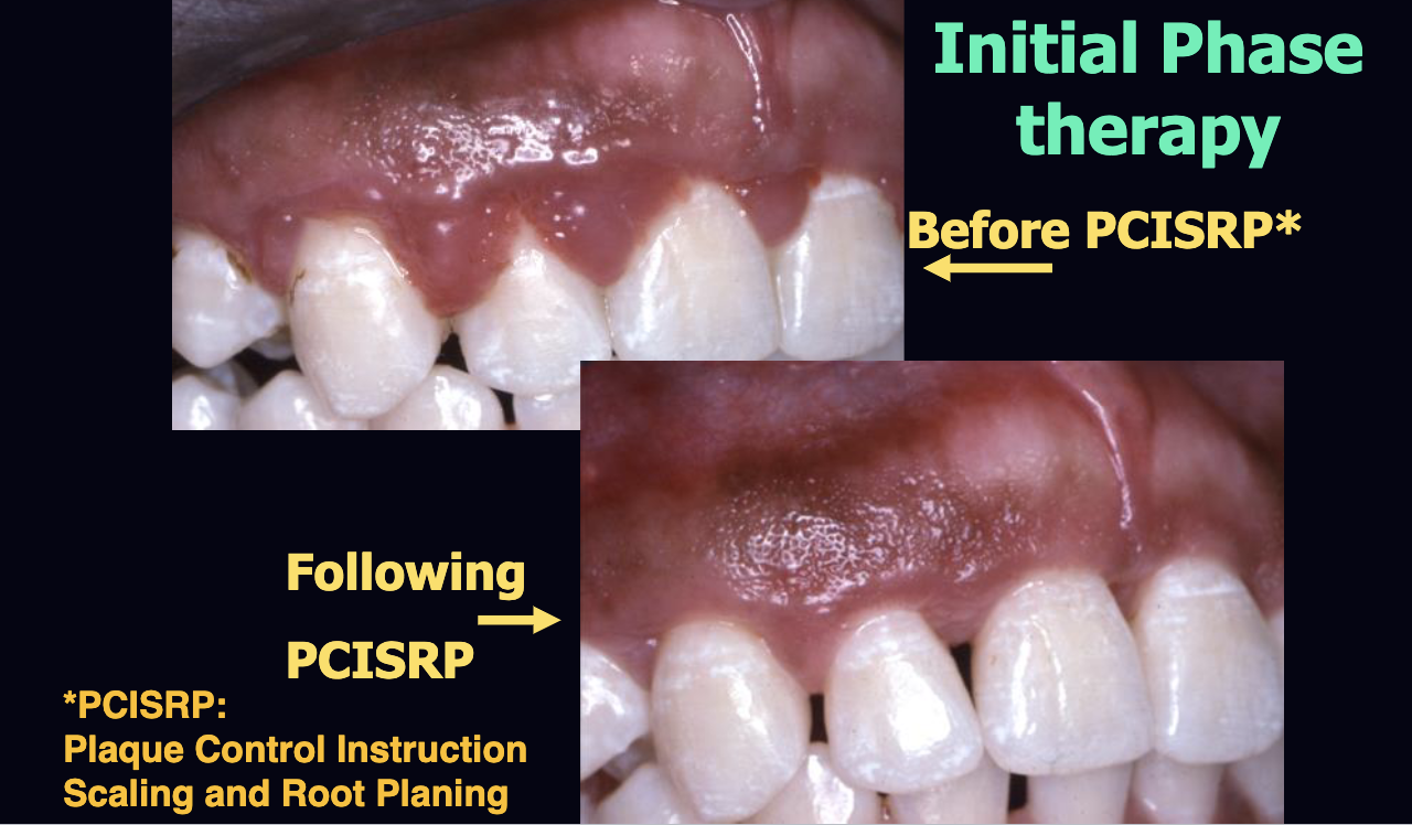 <p>plaque control instruction scaling and root planing</p>