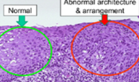 <p>cell development and maturation are disturbed → size abnormality</p>