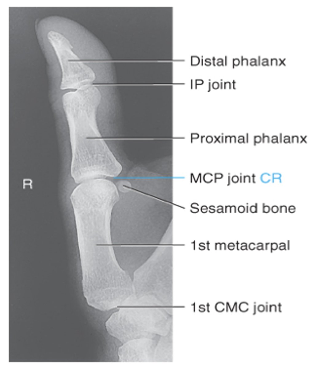 <p>-entire finger and entire metacarpal from distal thumb to trapezium</p><p>-Open IP and MCP joint spaces</p><p>-concave surface of elevated side of proximal phalanx and metacarpal</p>