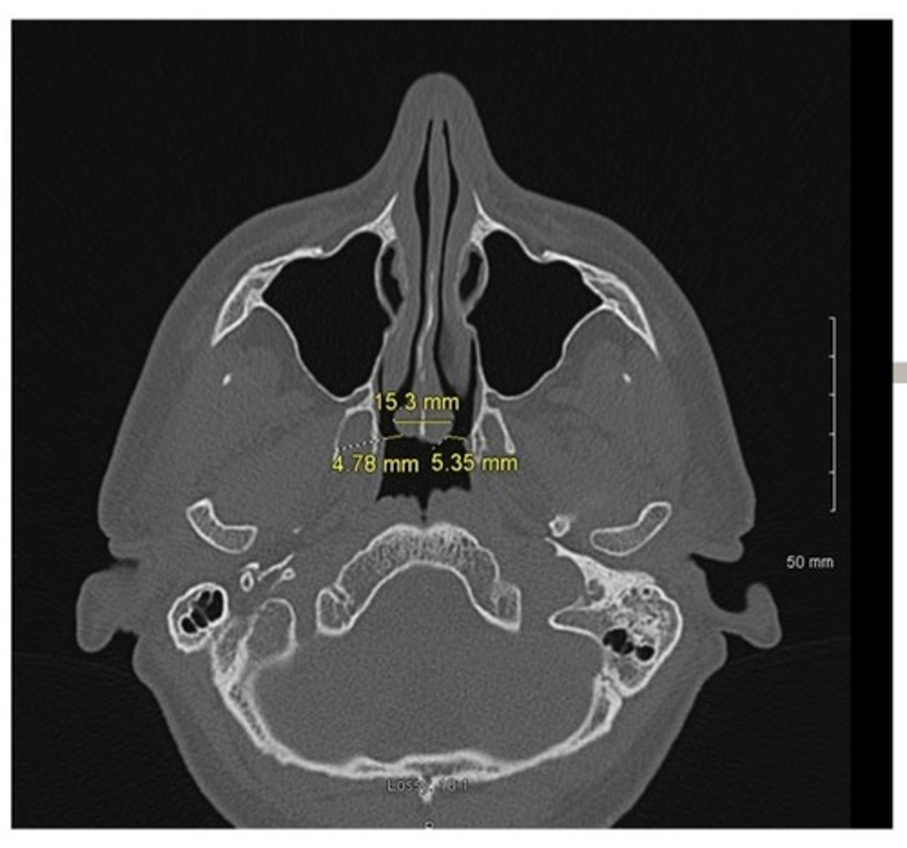 <p>1. Divides into top and bottom</p><p>2. An anatomic cut from ear to ear</p><p>3. An anatomic cut through both eyes</p><p>4. An anatomic cut through the mouth</p><p>5. Also called a transverse cut</p><p>6. Also called a horizontal cut</p>