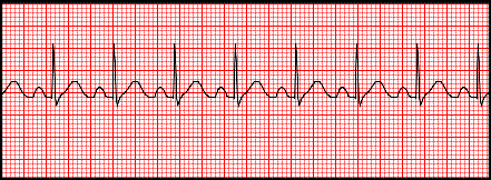 <p>Tachycardia</p>
