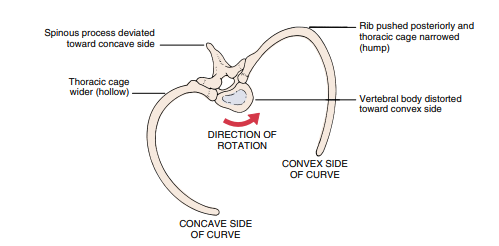 <p>Structural scoliosis effects:</p><ul><li><p>vertebral bodies rotate towards the <strong><u>convexity of the curve</u></strong></p></li><li><p>ribs on the convex side of the curve to push <strong><u>posteriorly </u></strong></p></li><li><p>The thoracic cage narrows on the <strong><u>convex </u></strong></p></li><li><p>The ribs move anteriorly on the <strong><u>concave side</u></strong></p></li><li><p>A “hollow” and a widening of the thoracic cage occurs on the <strong><u>concave side</u></strong></p></li></ul><p></p>