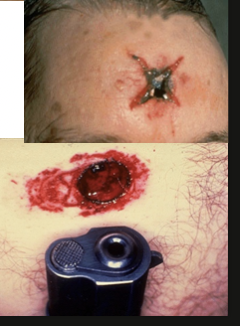 <ul><li><p><span>circular and smaller</span></p></li><li><p><span>stellate over scalp</span></p></li><li><p><span>burning /blackening of immediate wound edges</span></p></li><li><p><span>soot within tissues</span></p></li><li><p><span>muzzle mark</span></p></li><li><p><span>inverted wound margins</span></p></li><li><p><span>back spatter = blood sucked up into the barrel of the weapon</span></p></li></ul><p></p>