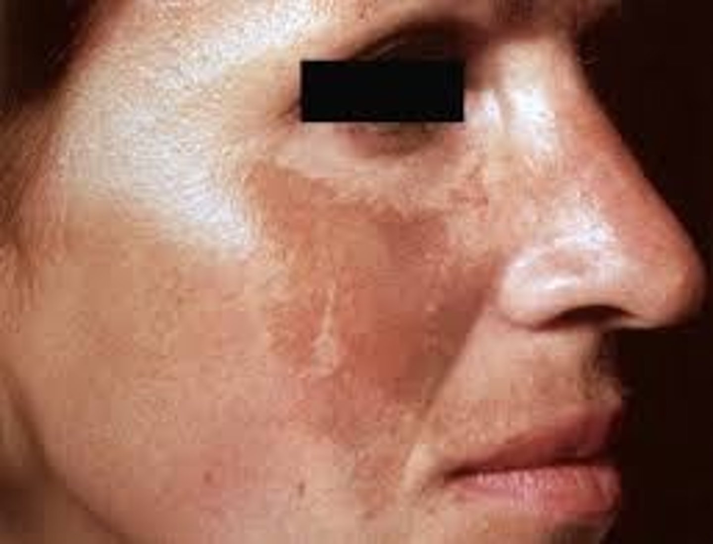 <p>Mark of pregnancy </p><p>Macular light-to-brown, hyperpigmentation that occurs in sun-exposed areas </p><p>Color is usually uniform and symmetric </p><p>Lesions has serrated, irregular and geographic borders </p><p>May disappear</p>