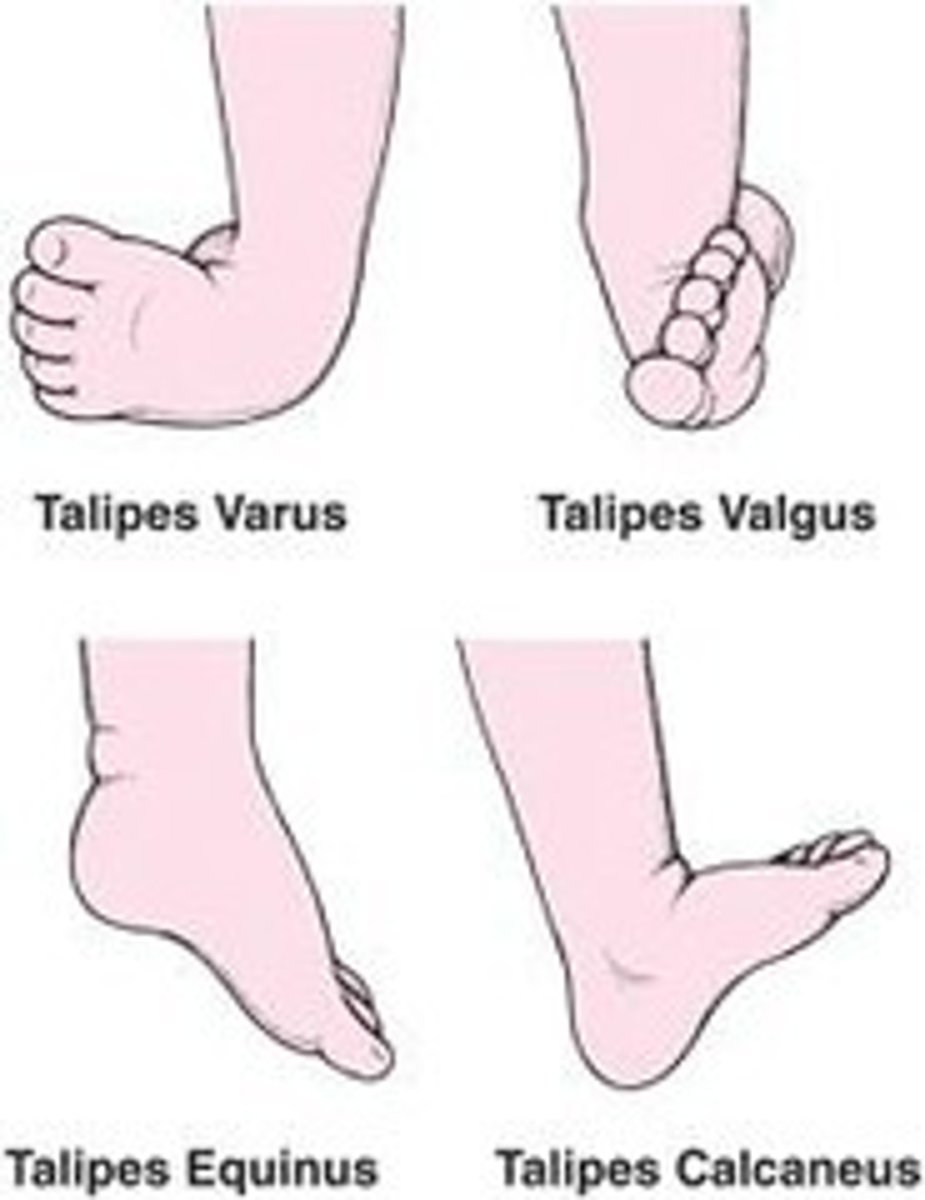 <p>- talipes</p><p>- congenital hip dislocation</p>
