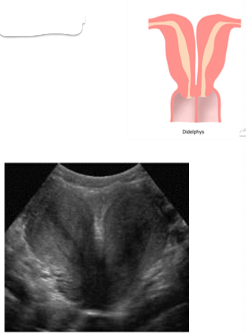 <p>– Double vaginas, cervixes, and uteri function separately</p><p class="p1">– The two uteri are at approximately a 450 angle to one another</p>