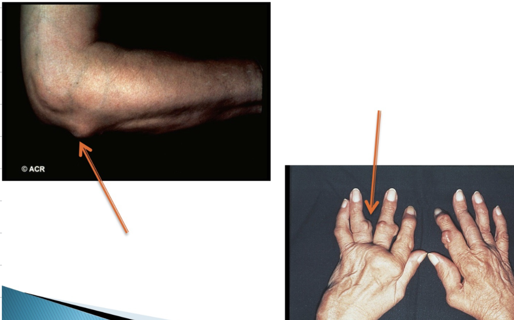 <p><mark data-color="#ffb6e8" style="background-color: #ffb6e8; color: inherit">RA causes different deformities of the joint. Explain what is seen in the following image.</mark></p>