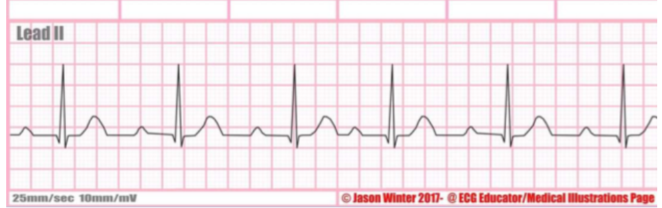 <p>type of abnormality + characteristics? (PR interval  &gt; 0.20 secs)</p>