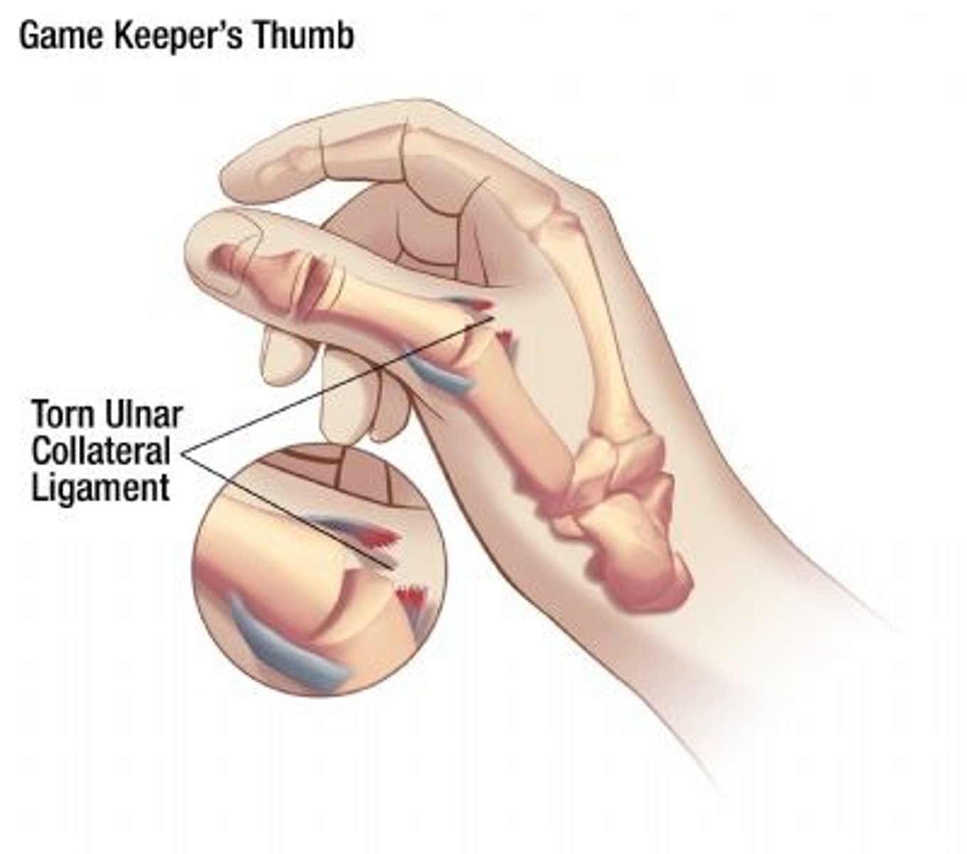 <p>Injury to the ulnar collateral ligament (UCL) of the thumb or the thumb metacarpophalangeal (MCP) joint</p>