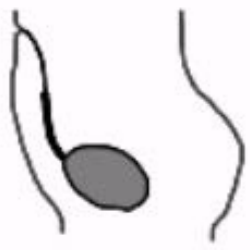 <ul><li><p>About 5% of cases</p></li><li><p>Closes at umbilicus but remains patent at bladder</p></li></ul><p></p>