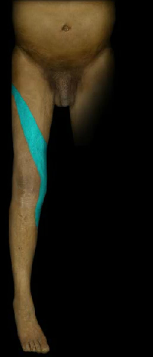 <p>Medial knee</p>