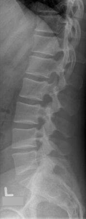 <p>no shoulder / pelvic rotation</p><ul><li><p>MAIN: VB post.margs SI ant/post</p></li><li><p>open IVF </p></li><li><p>T12 rib pairs and pelvic alas SI adeq</p></li></ul><p></p>