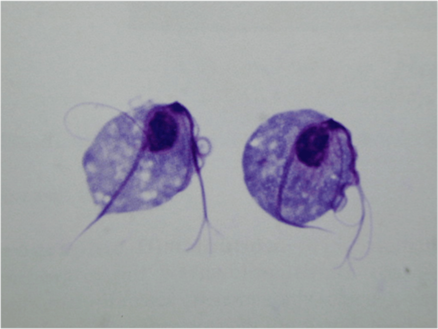 <p>Trichomoniasis</p><p>Protozoa - Excavata</p><p>sexually transmitted disease (STD)</p><p>flagellae, mononucleate, granular</p>