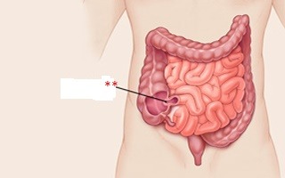 valve between the ileum of the small intestine and the cecum of the large intestine; prevents material from flowing back from the large to the small intestine