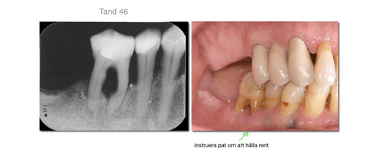 <p>Tandlossning där inflammationen lett till en vävnadsdestruktion där alveolarbenet tillbakabildats och kan få tanden att lossna.</p>
