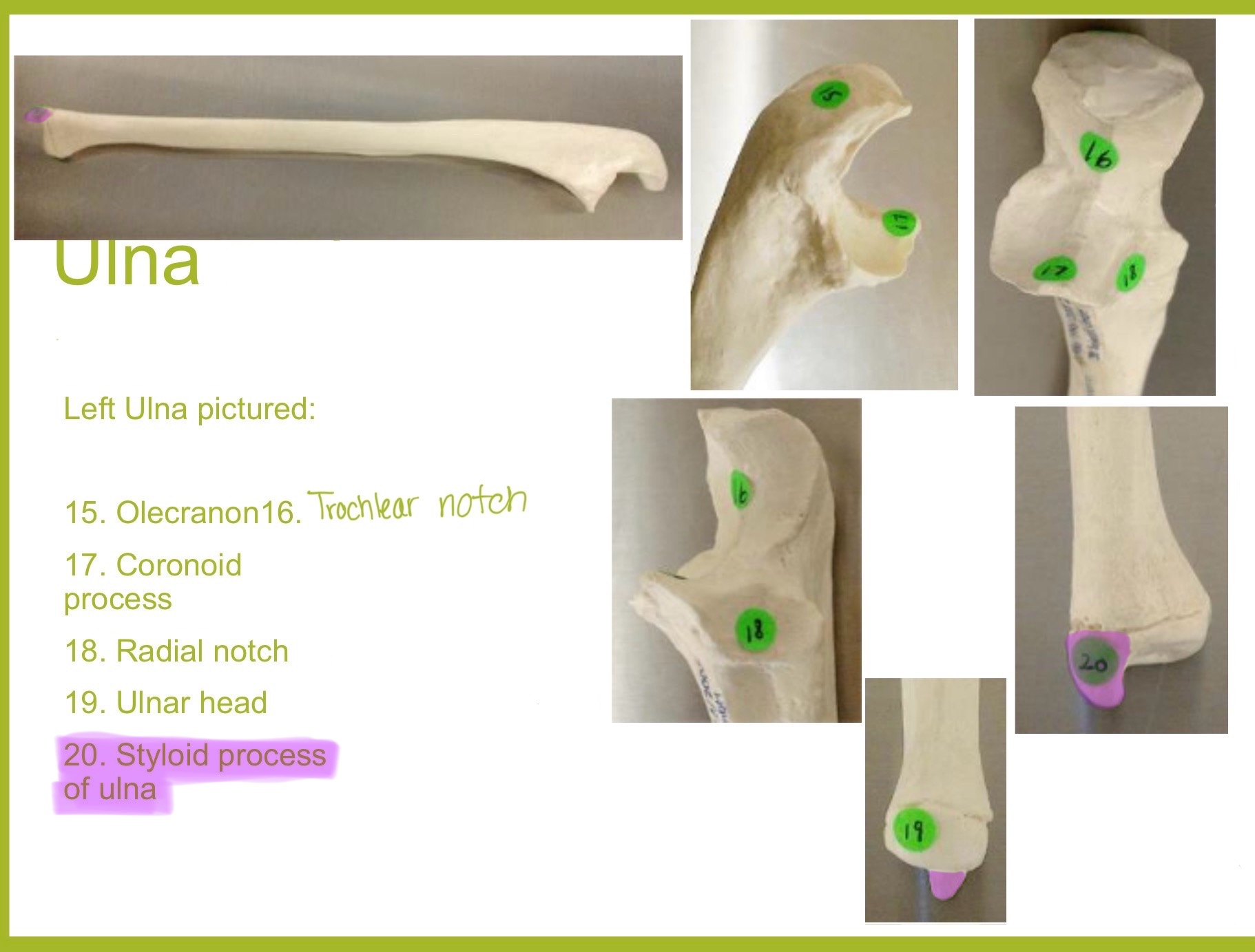 <p>styloid process of ulna</p>