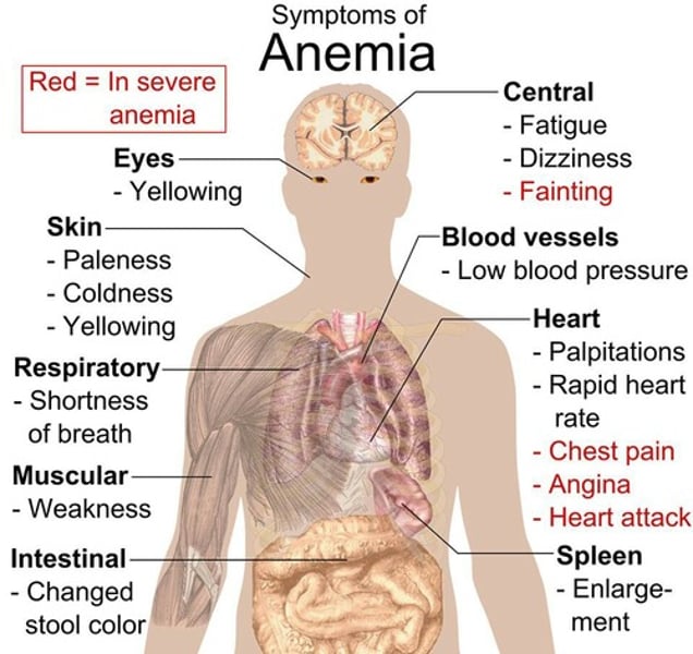 <p>deficiency of red blood cells or hemoglobin</p>