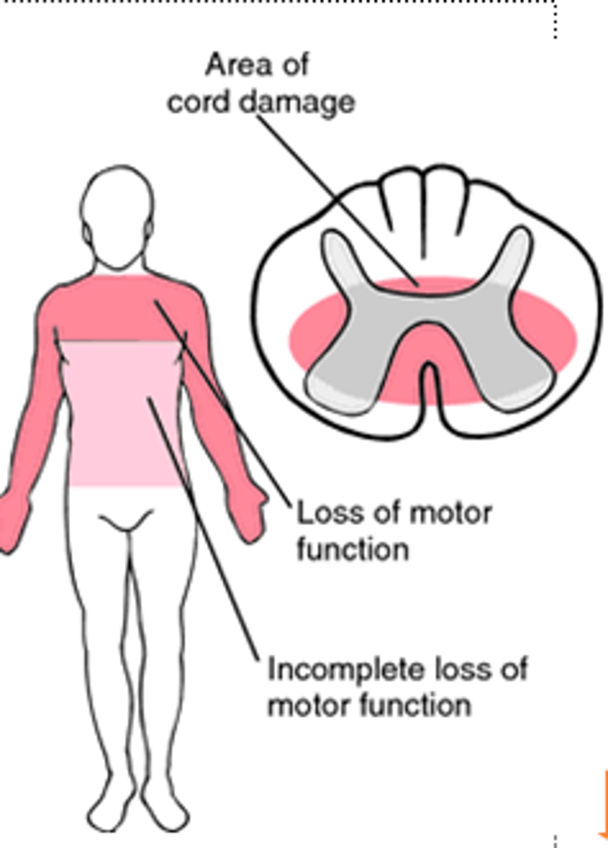 <p>Injury results in sacral sparing and preferentially upper- more than lower-extremity weakness.</p>