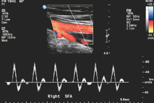 <p>Which form of doppler velocimetry is seen here?</p>