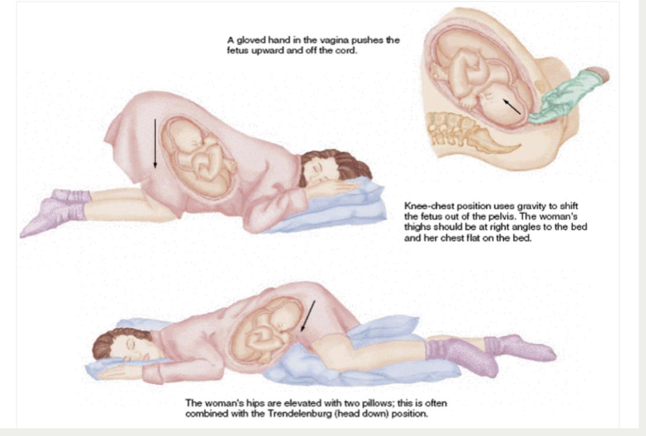 <p><strong>fetal complication</strong></p><ul><li><p>occlusion of blodo flow &gt; 5 min —&gt; central nervous system damage, asphyxia, death</p></li></ul><p></p><p><strong>management</strong></p><ul><li><p>call for additional assistance</p></li><li><p>hold up the presenting part</p><ul><li><p>you keep your fingers in until baby is delivered</p></li></ul></li><li><p>trendelenburg or knee chest position </p></li><li><p>02 and iv fluid bolus</p></li><li><p>emergency cesarean</p></li></ul><p></p>