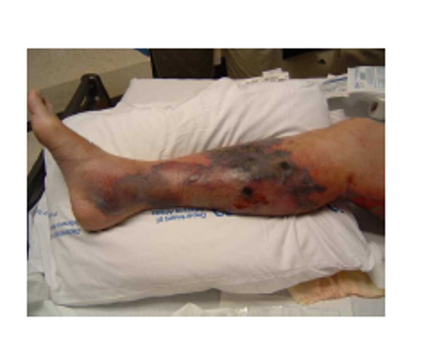 <p>necrotic destruction of muscles/tissues, pockets of air/gas under skin, purple bullae (necrosis)</p>