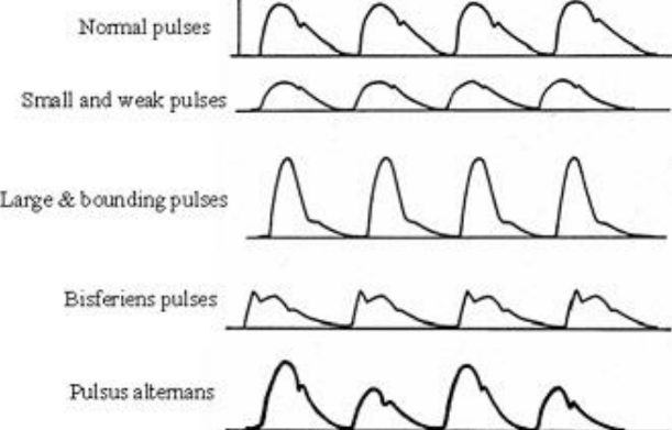 <p>Bisferiens pulse.</p>