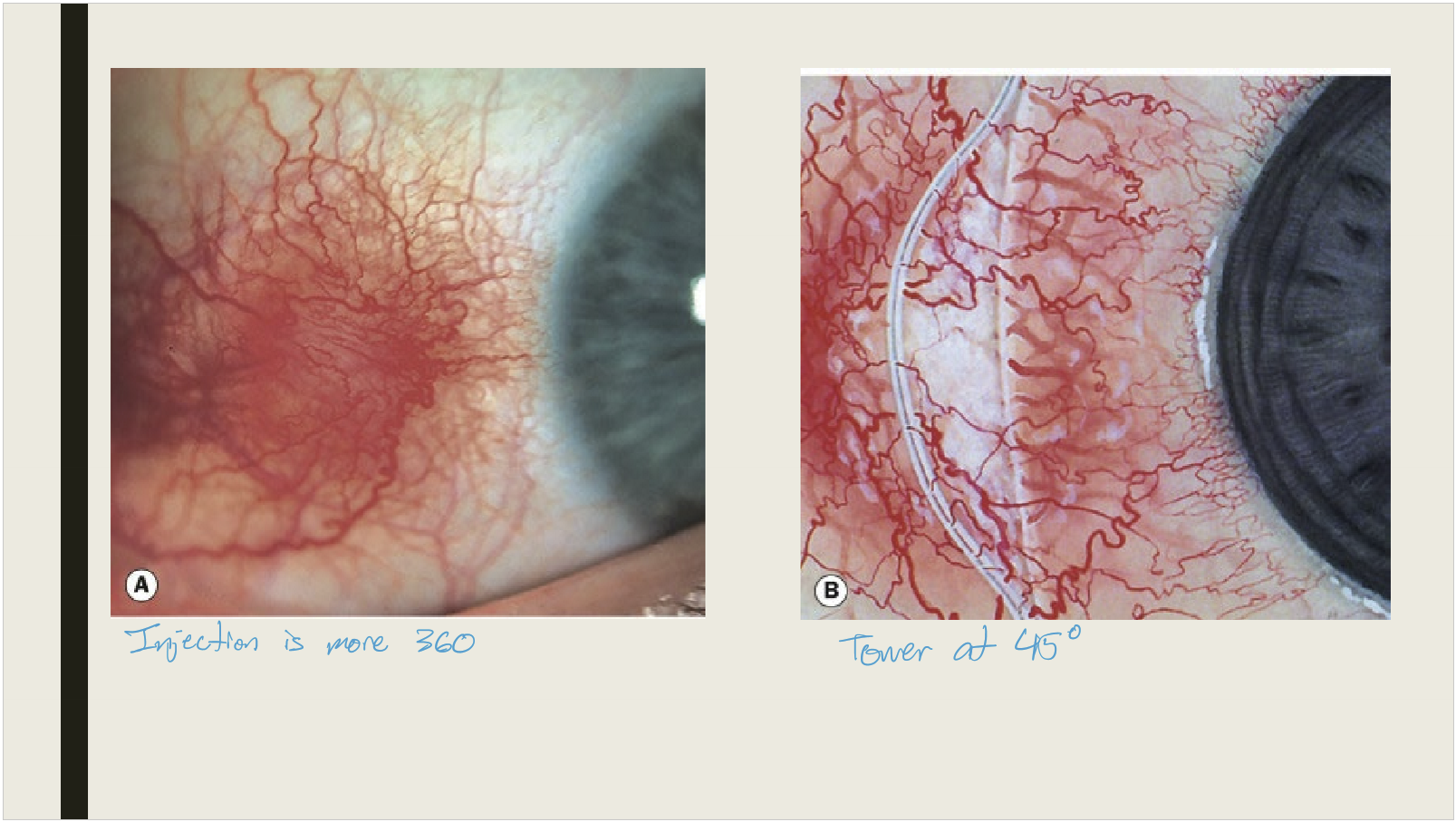 <ul><li><p>Mild cases: observation or artificial tears</p></li><li><p>Moderate/severe: topical steroids or oral NSAIDs</p></li></ul><p></p>