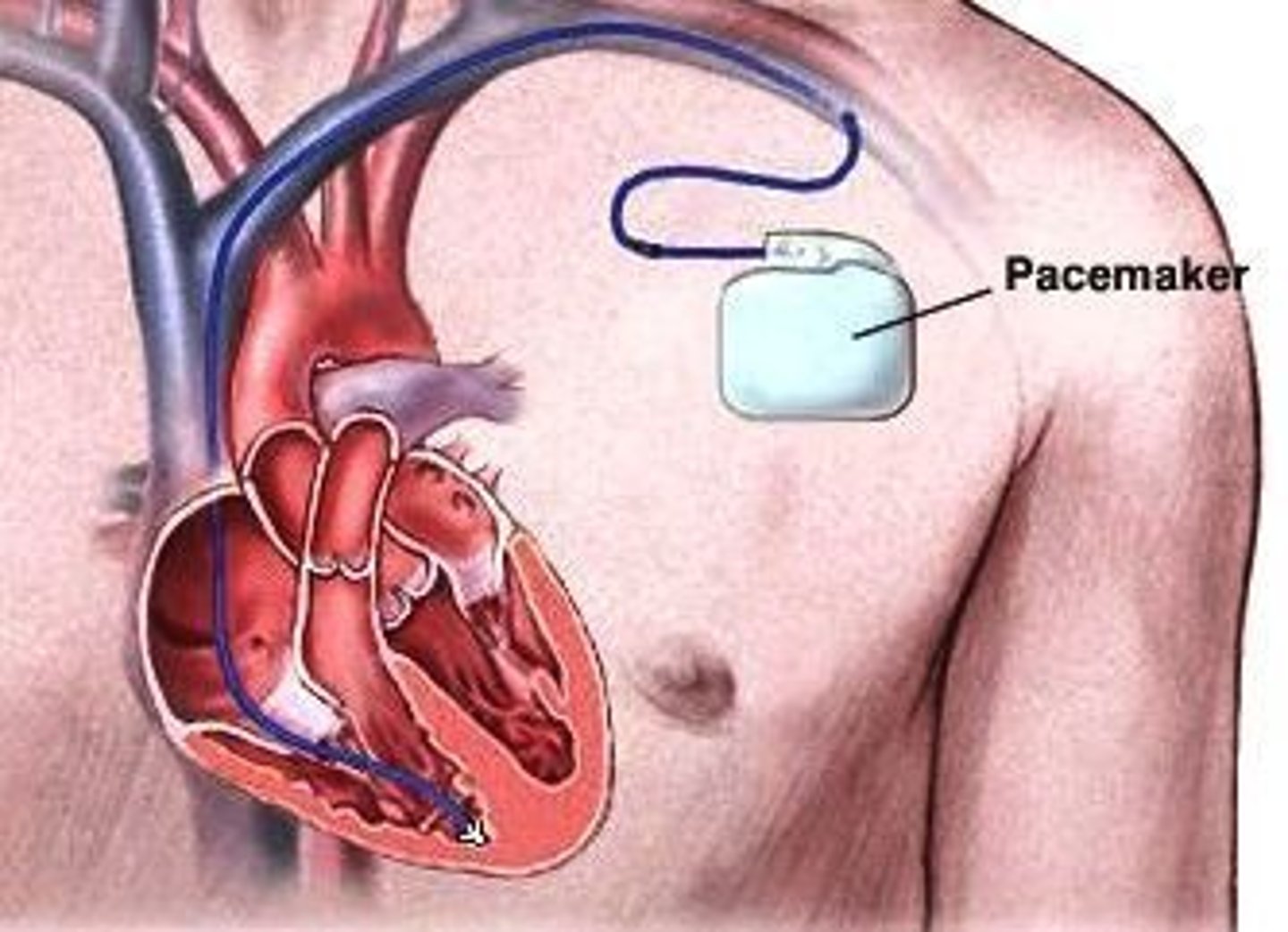 <p>Máy tạo nhịp tim - thiết bị điều chỉnh nhịp tim. (He had a pacemaker implanted - Anh ấy được cấy máy tạo nhịp tim.)</p>