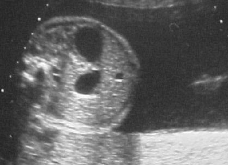 <ul><li><p><strong>2 anechoic structures in upper abdomen</strong></p></li><li><p>polyhydramnios</p></li><li><p>cardiovascular anomalies</p></li><li><p>horseshoe kidneys, ectopic kidneys</p></li><li><p>Imperforate anus</p></li><li><p>Atresia of small bowel</p></li><li><p>Esophageal atresia</p></li><li><p>Symmetric FGR</p></li><li><p><strong>AFP in amniotic fluid</strong> d/t&nbsp;<span><span>↓ swallowing</span></span></p></li></ul><p></p>