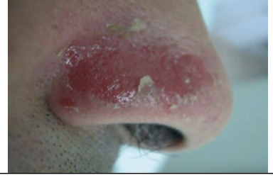 <span style="color: rgb(5, 3, 3);"><span>What kind of skin condition is this?</span></span>