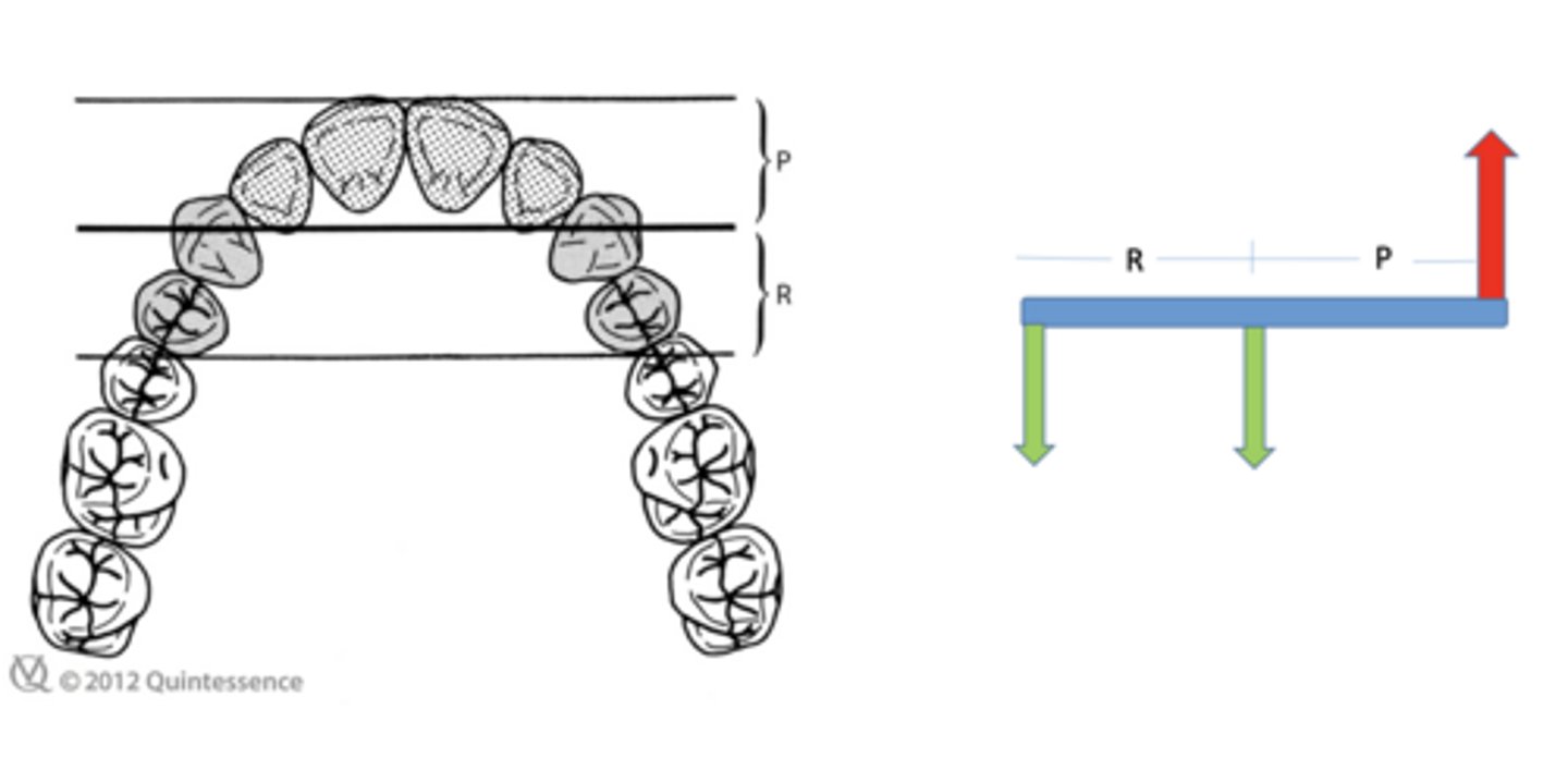 <p>What must extend a distance from the primary interabutment axis equal to the distance that the pontic lever arm (P) extends in the opposite direction?</p>