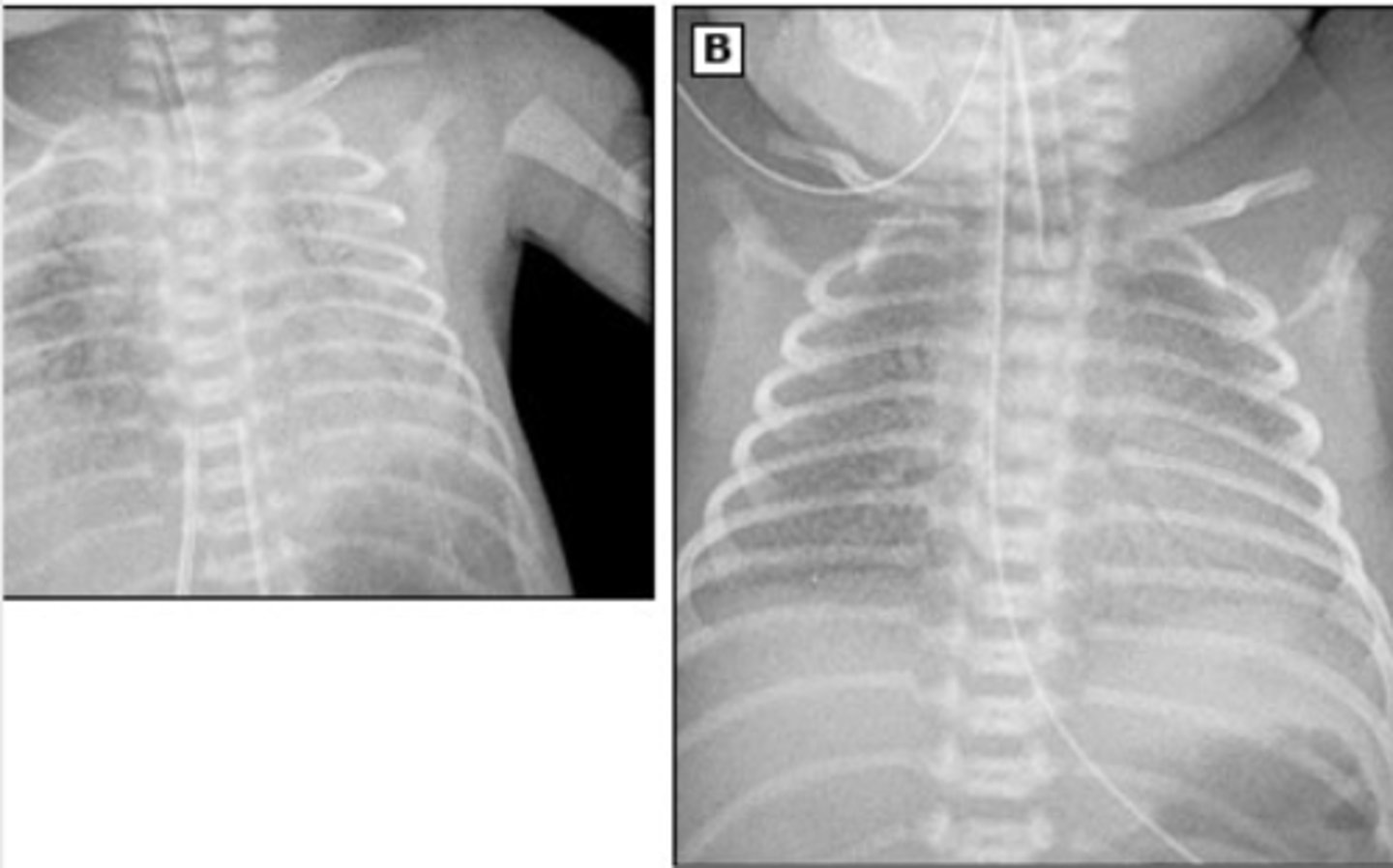 <p>Imaging shows characteristic low lung volume and diffuse reticulogranular ground glass appearance with air bronchograms</p>